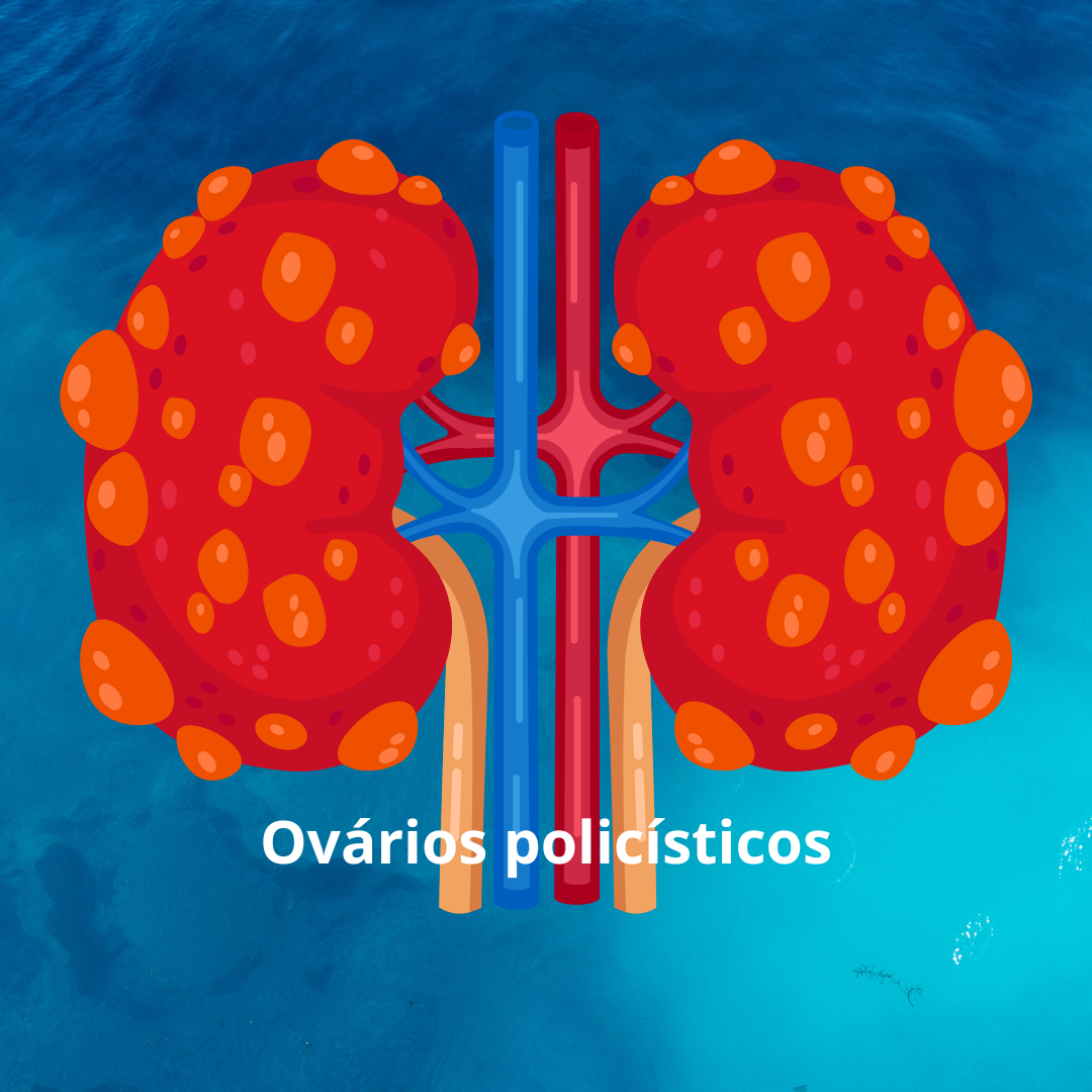 SÍNDROME DO OVÁRIO POLISÍSTICO